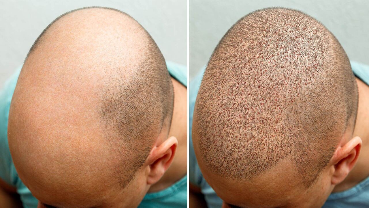 New Delhi, Health, Best Hair Treatment In Delhi
