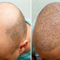 Best Hair Treatment In Delhi