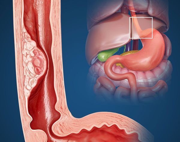 Ghaziabad, Health, Expert Care For Esophageal Cancer In Noida | Dr. Manish Singhal