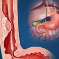 Expert Care For Esophageal Cancer In Noida | Dr. Manish Singhal