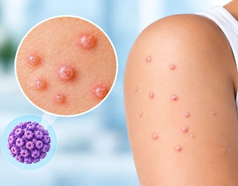 Hyderabad, Health, Molluscum Contagiosum: Treatment & Prevention Guide In Kukatpally