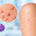 Molluscum Contagiosum: Treatment & Prevention Guide In Kukatpally