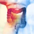 Colon Cancer Care & Treatment In Noida | Dr. Manish Singhal