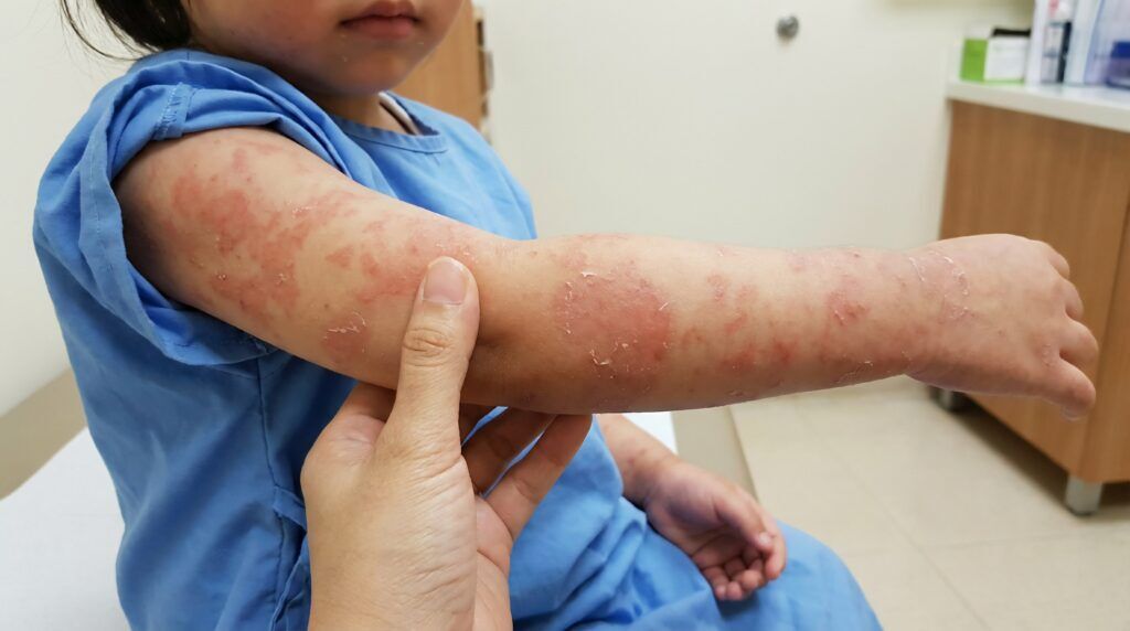 New York, Health, Find Skin Allergy Diagnosis And Treatment Near You In California